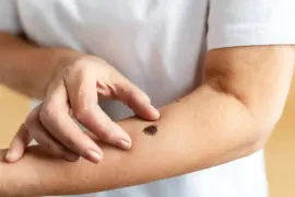 Kanser türlerinden melanom cinsiyete göre değişiyor