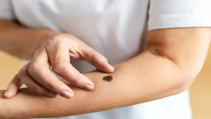 Kanser türlerinden melanom cinsiyete göre değişiyor haberinin görseli